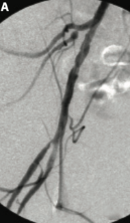 Datillo Endovascular TN