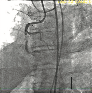 DeMartini ARTIS case TN