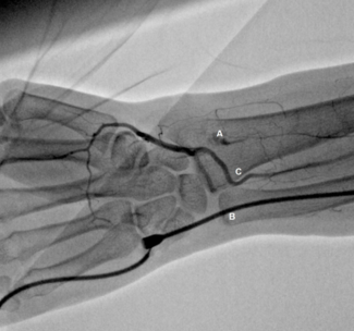 Duarte Ipsilateral Ulnar Access TN