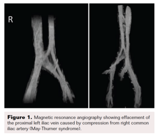 Fig 1. May-Thurner syndrome