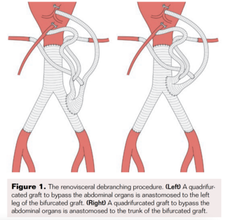 Fig 1. Renovisceral debranching procedure 