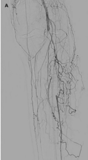 Giannopoulos Lithotripsy TN