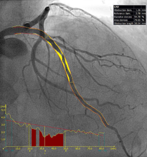 Gitto Angiographic Lesion TN