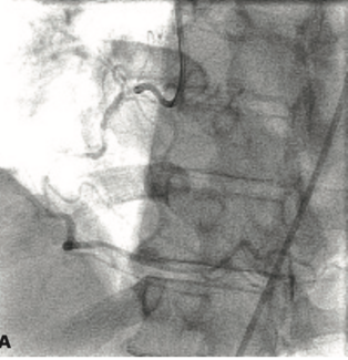 Kumar Stent Entrapment TN