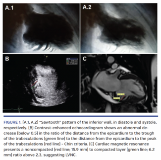 Left Ventricular Noncompaction