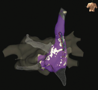 Lorvidhaya Cardioneuroablation TN