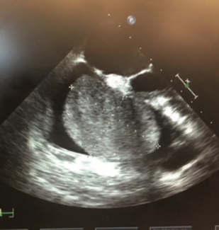 Minhas Pulmonary Embolism TN