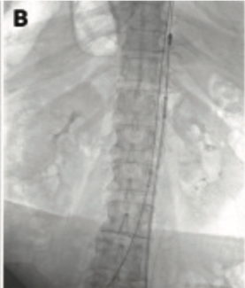 Misono Deep Vein Thrombosis TN