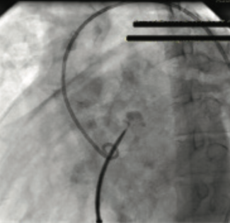Nasir Aortic Root Puncture TN