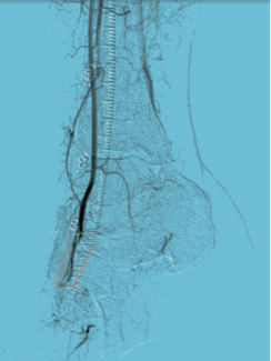Rao Limb Preservation TN