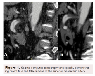Sagittal CT showing patent true and false lumens. 