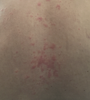 dermatitis