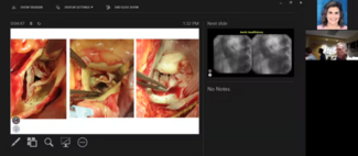 Regurgitant Aortic Valve: Morton Kern, MD