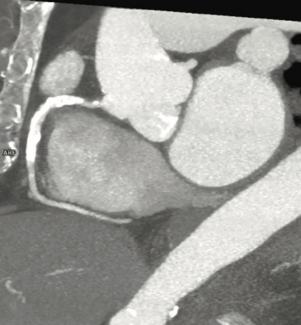 Siemens Imaging Corner Stent Fracture TN