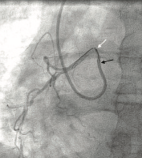 Singh Guide Cath Extension TN
