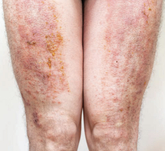 eczema legs severe