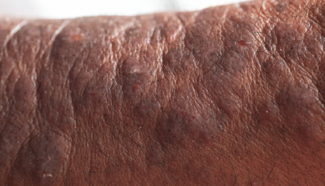 severe eczema lichenification