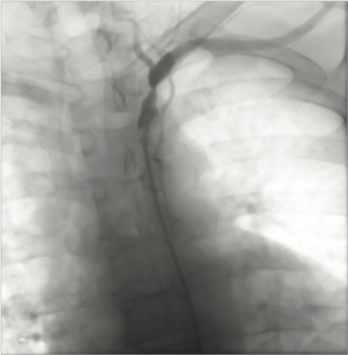 Ahmed Peripheral Artery TN