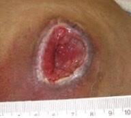 Pressure Injury