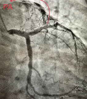 Casazza Coronary Artery Fistula TN