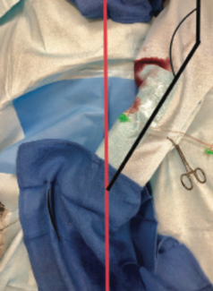 Casazza-Peek Left Radial Artery TN