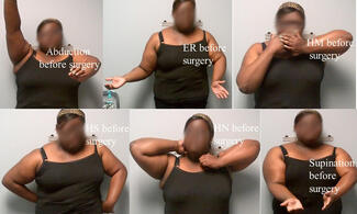 Figure 1. Modified Mallet movements of a 28-year-old woman with OBPI before surgery.