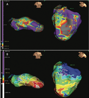Goldstein Catheter Ablation TN