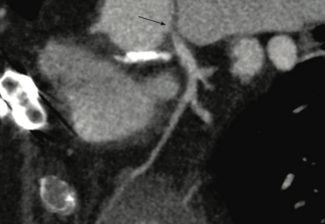 Hoppe Synergy Megatron TN