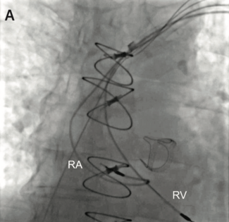 Issa Transvenous Lead TN