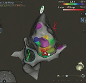 Leyton Premature Ventricular Contractions TN