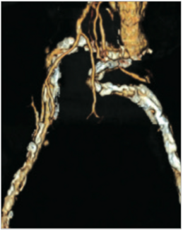 Lichaa Critical Limb Ischemia TN