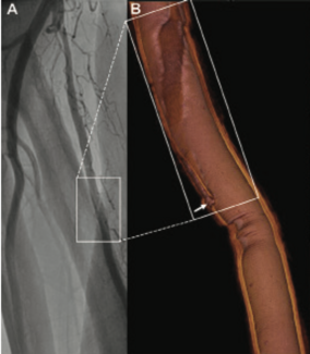 Liu Spiral Dissection TN