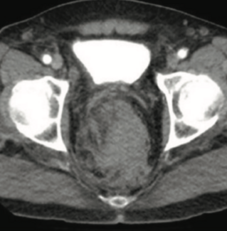 Minhas Ischemic Stroke TN