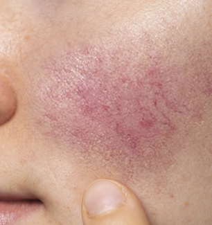 rosacea-cheek