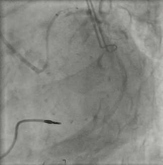 Varga Guide Extension TN