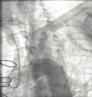 Varga Subclavian Artery TN