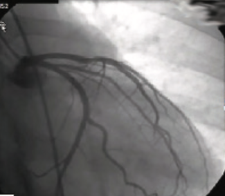 Vlad Myocardial Infarction TN