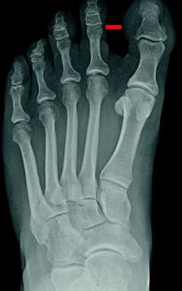 Hallux Varus