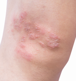 atopic dermatitis