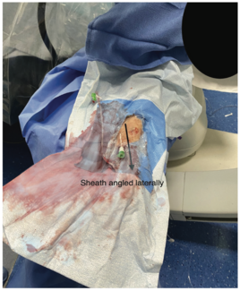 Casazza Left Ulnar TN