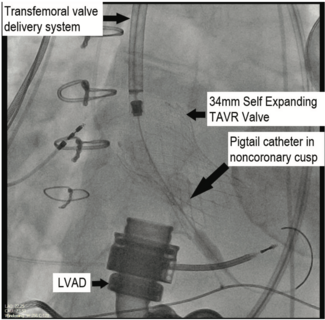 Dhillon Aortic Regurgitation TN
