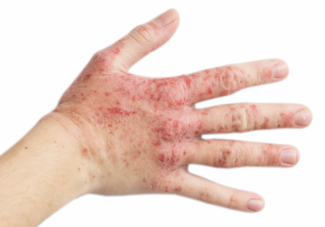 eczema on hand