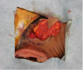 Figure 2. Operative findings, excised tumor.