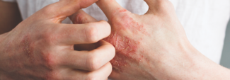 itchy hands 