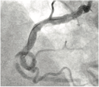Khatri Terumo Complex PCI TN