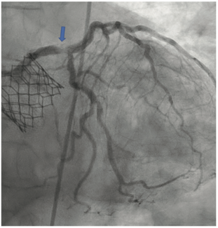 Nagaraja Intravascular Lithotripsy TN