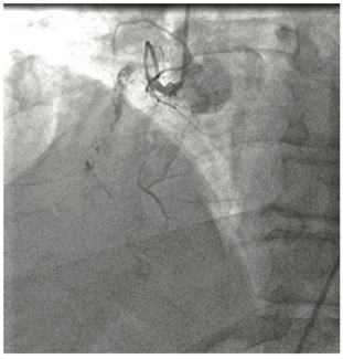 ShahSiemens Coronary CTA Fusion Figure 1