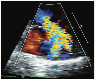 Siemens Mitral Regurgitation TN