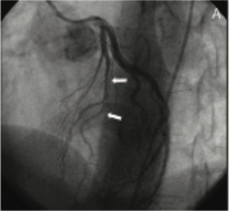 Wood Coronary Artery Dissection TN