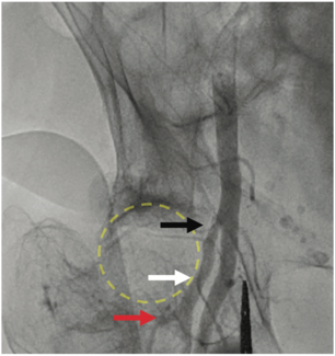 Wu Femoral Bifurcation TN